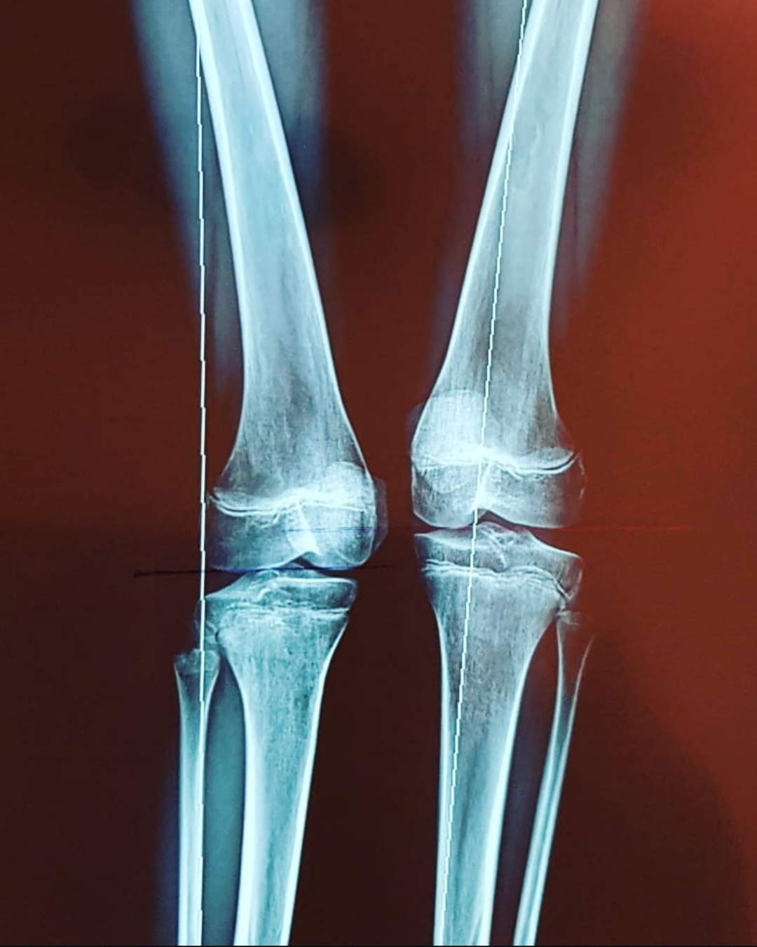 Total Knee Replacement (Total Knee Arthroplasty)