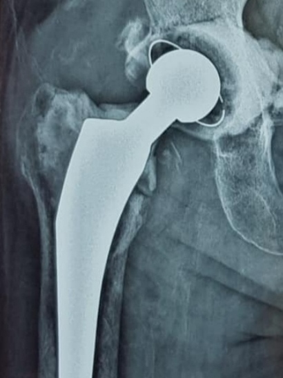 Total Hip Replacement ( Total Hip Arthroplasty )