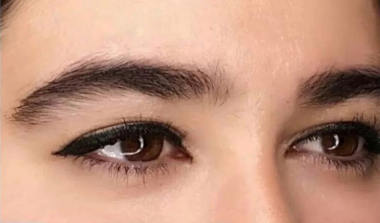 Endoscopic Eyebrow And Temple Lift Operation