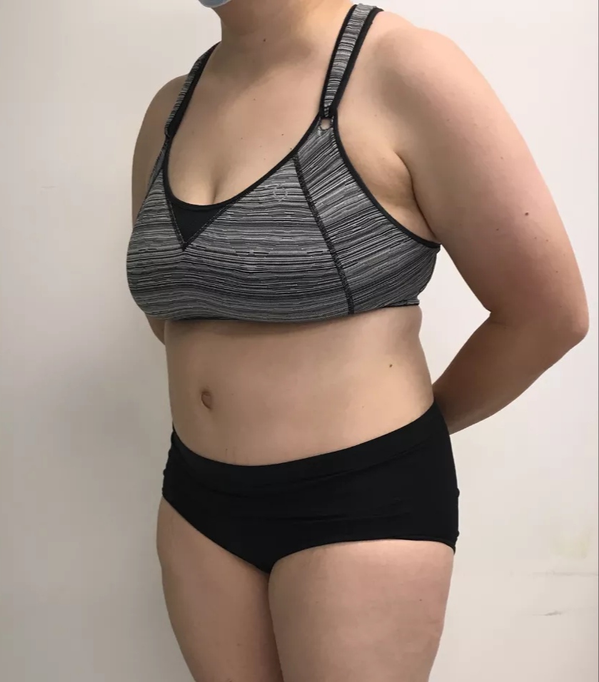 Abdominoplasty (Tummy Tuck)