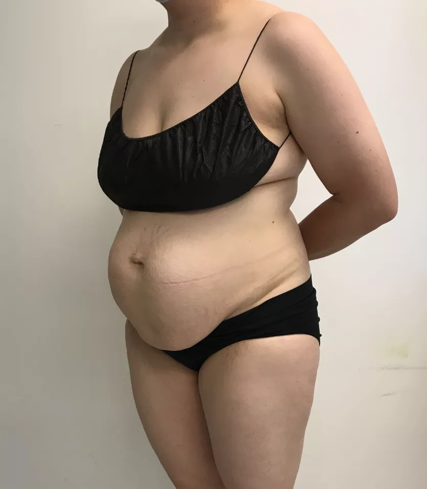 Abdominoplasty (Tummy Tuck)