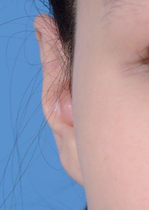 Ear Cosmetic Surgery