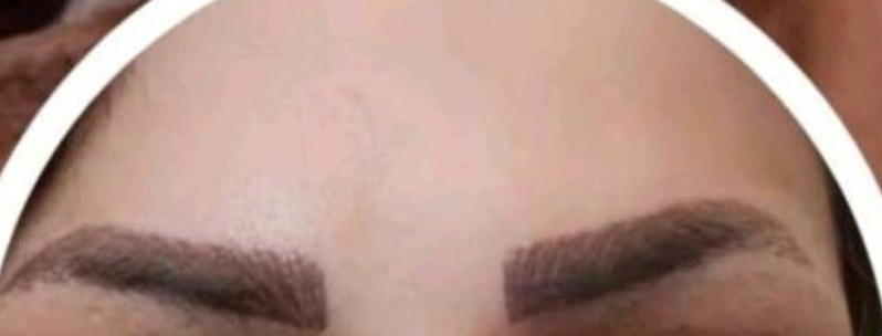 Eyebrow Transplant