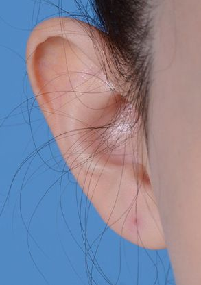 Ear Cosmetic Surgery