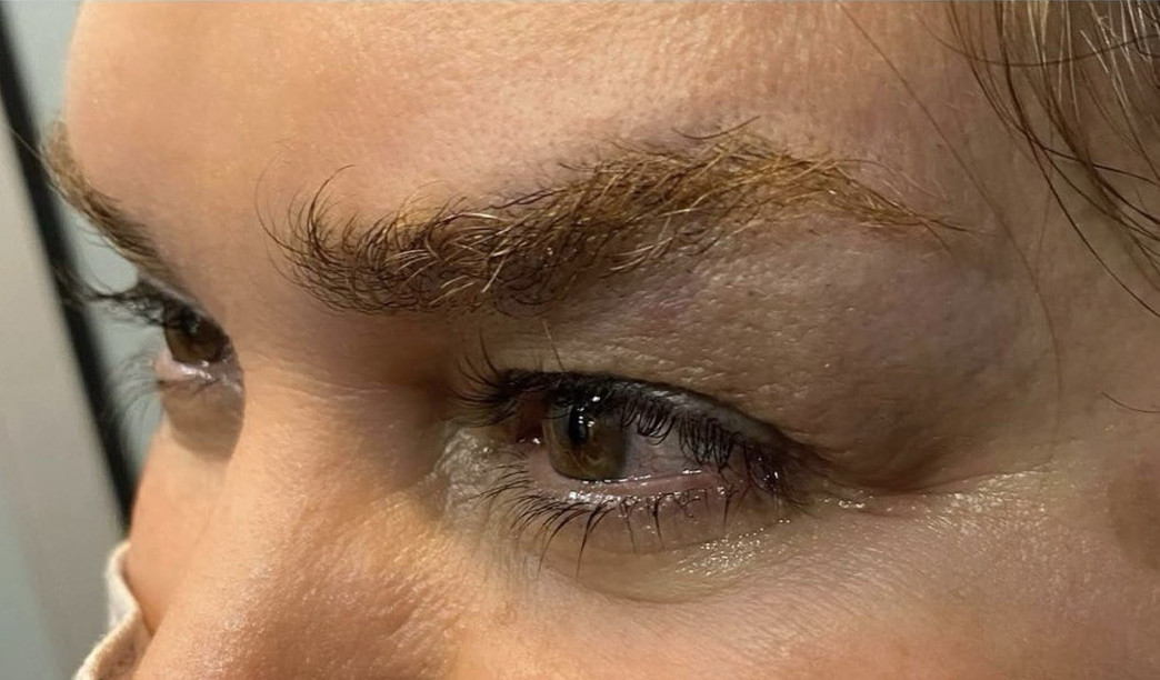Blepharoplasty