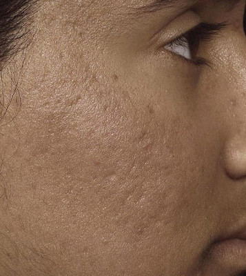 Carboxytherapy Facial