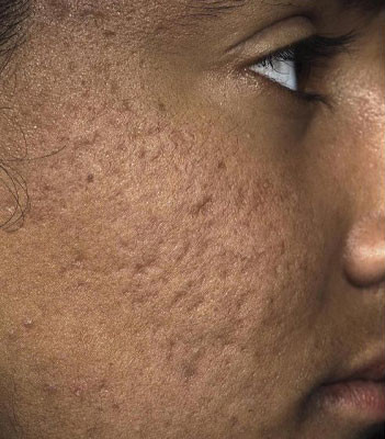 Carboxytherapy Facial