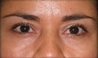 Cataract Surgery