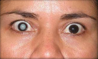 Cataract Surgery