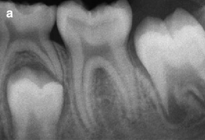Endodontics