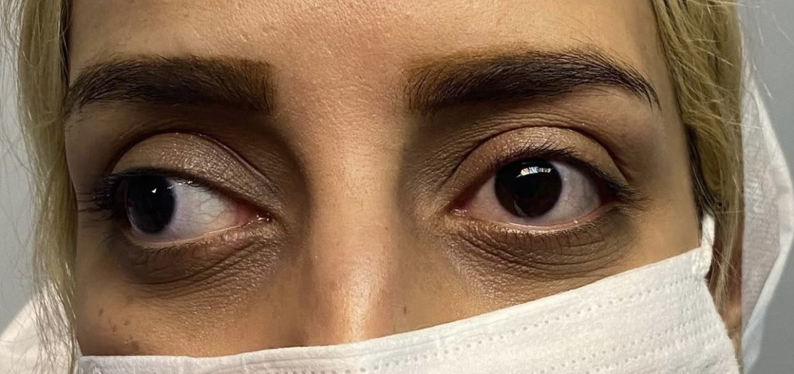 Eye Deflection Surgery