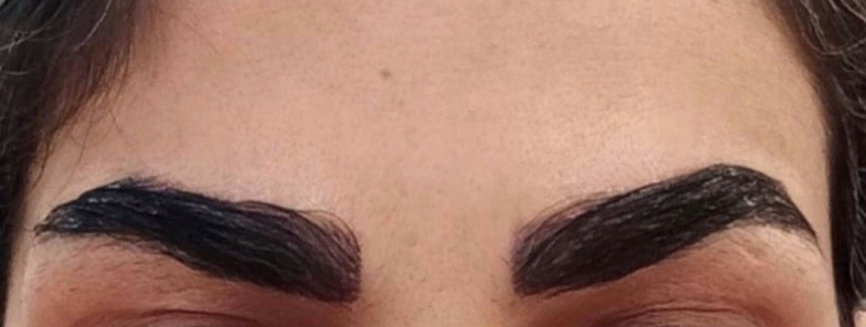 Eyebrow Transplant