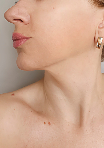 Facelift