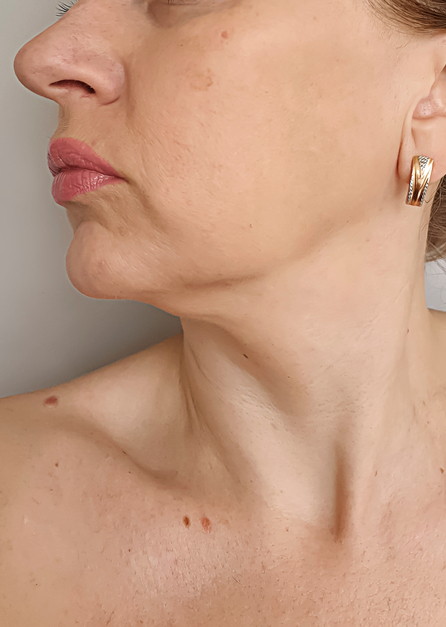 Facelift