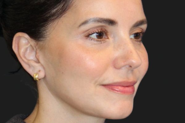 Facial