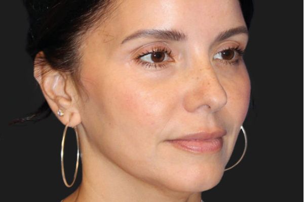 Facial