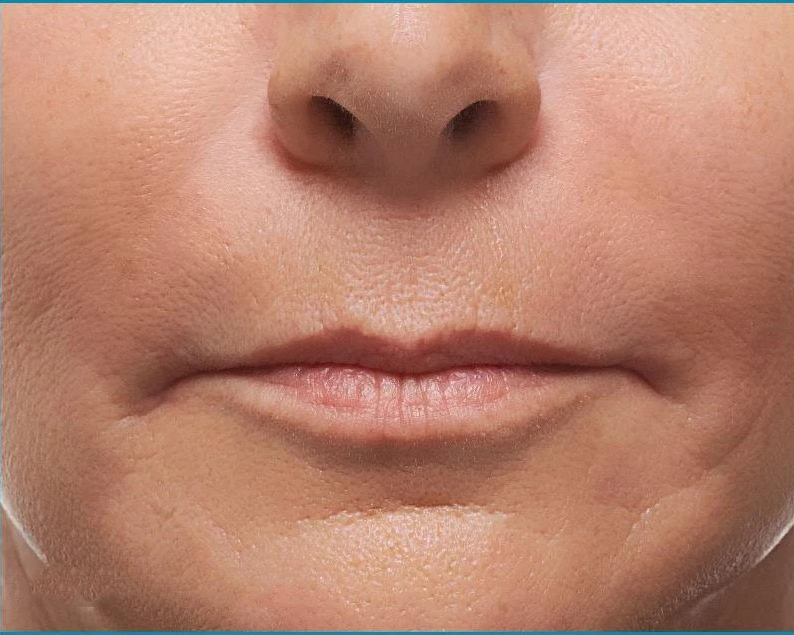 Facial Fillers
