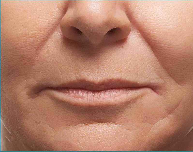 Facial Fillers
