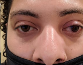 Glaucoma Surgery