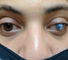 Glaucoma Surgery