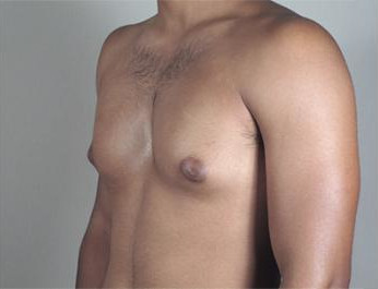 Gynecomastia Surgery