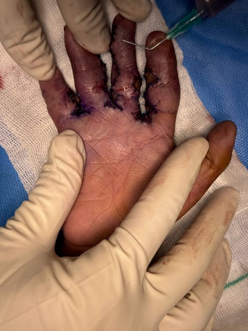 Hand Surgeries