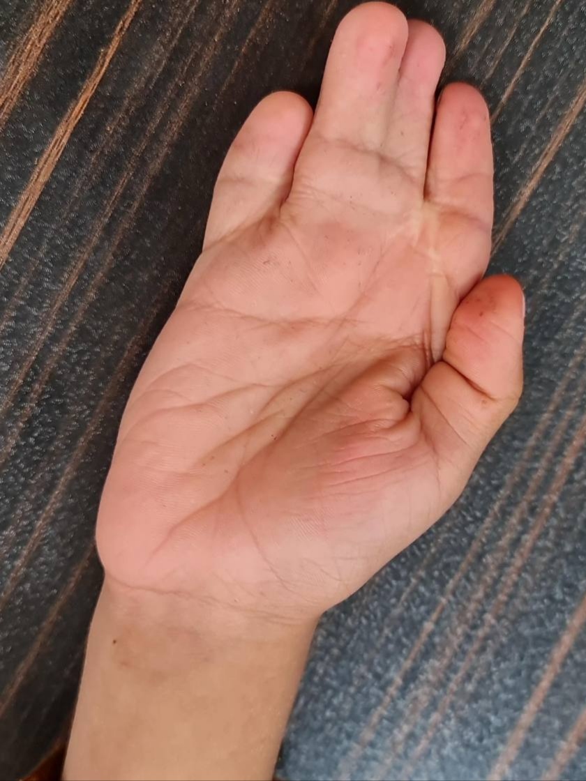 Hand Surgeries