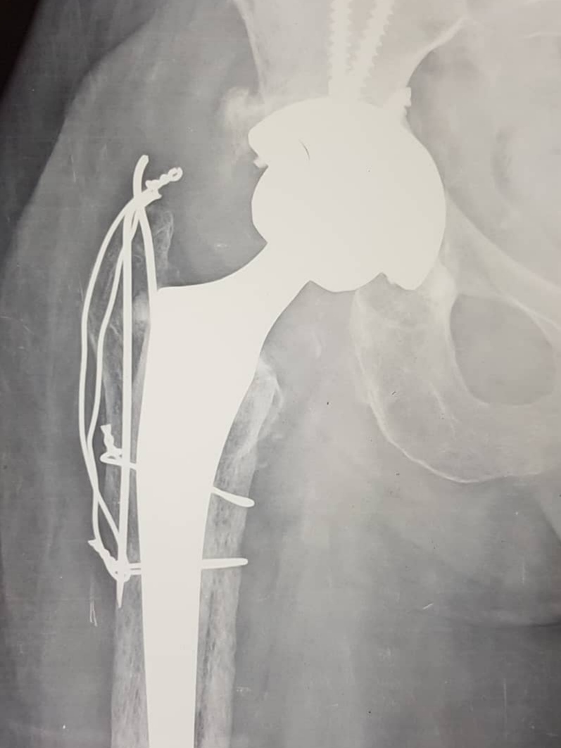Total Hip Replacement ( Total Hip Arthroplasty )