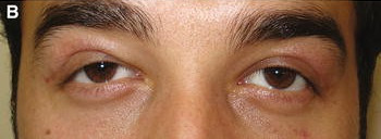 Lacrimal Duct Surgery