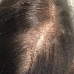 Facial Mesotherapy