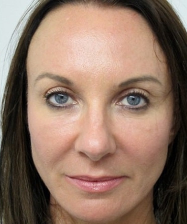 PRP Facial Fejuvenation