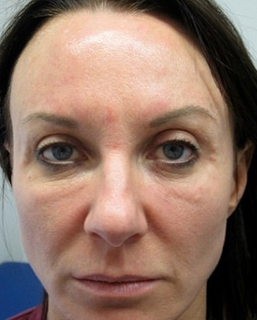 PRP Facial Fejuvenation