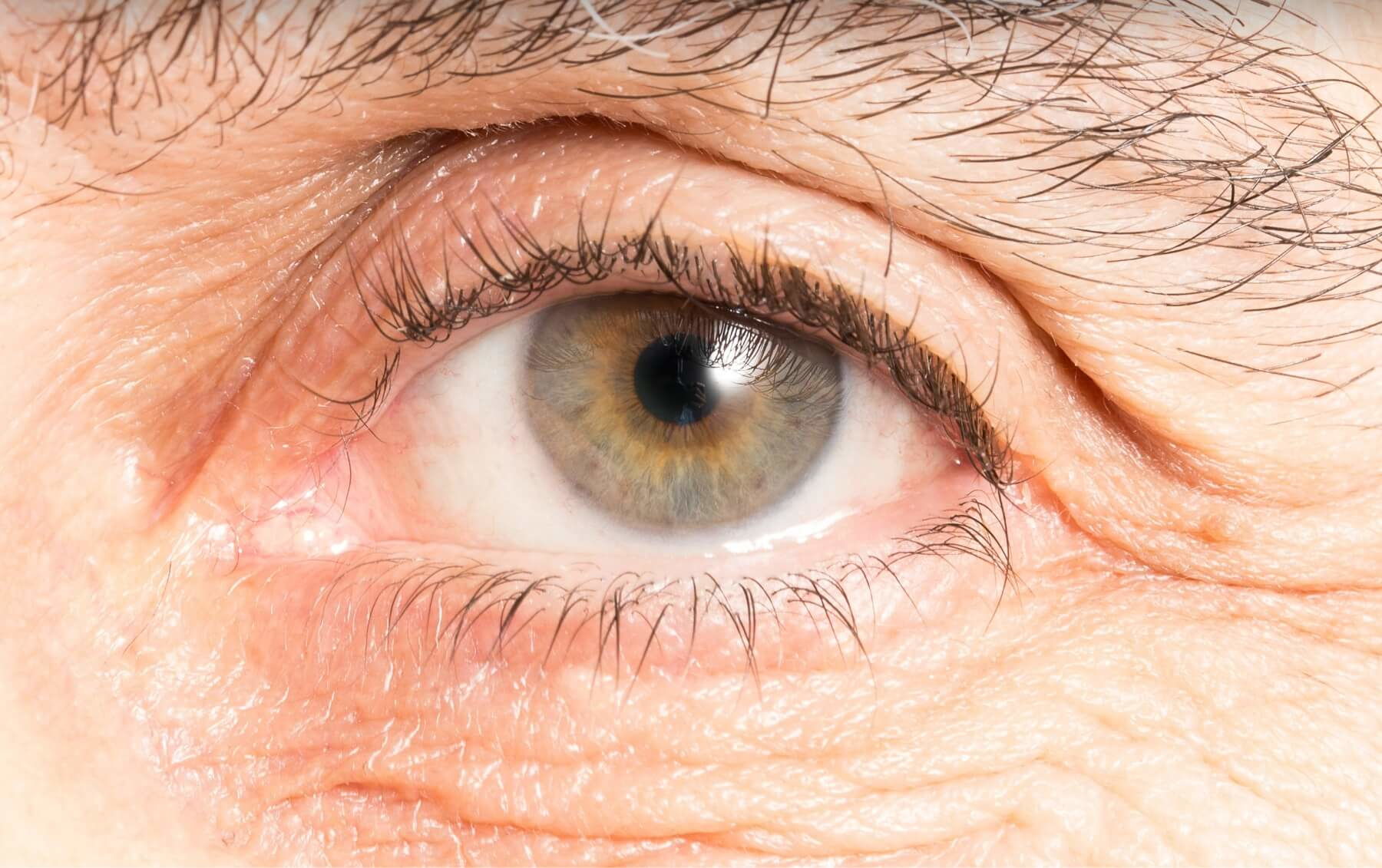 Pterygium Surgery