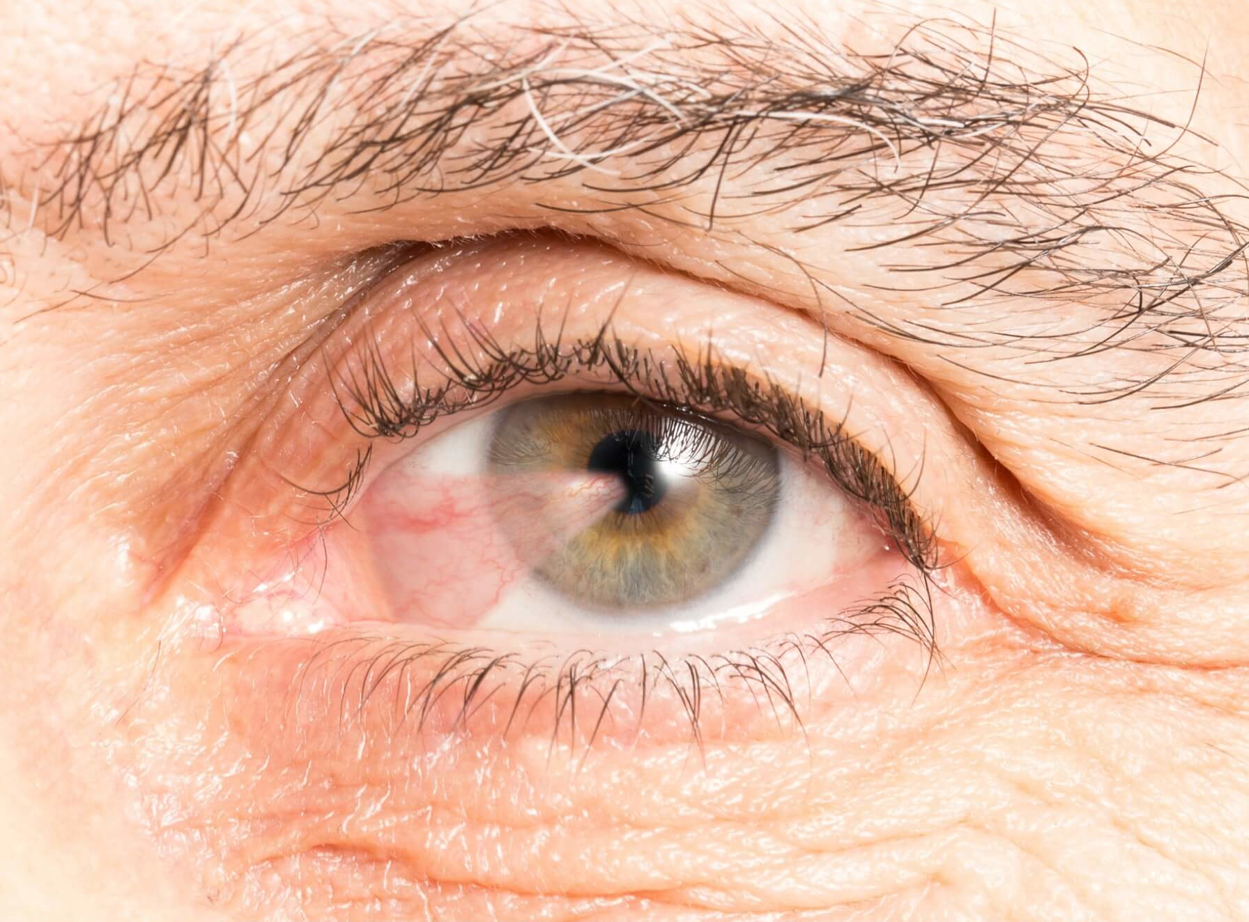 Pterygium Surgery