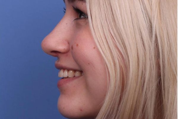 Nose
