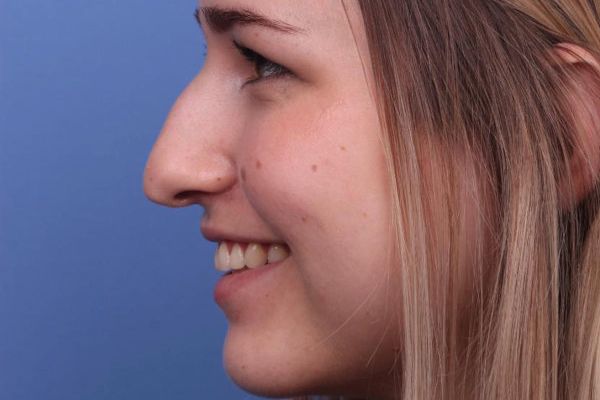Nose