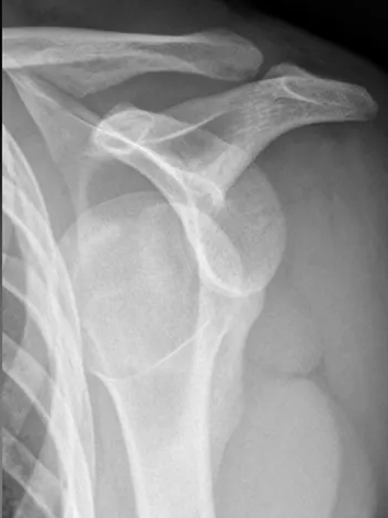 Orthopedic Surgery for Sports Injuries