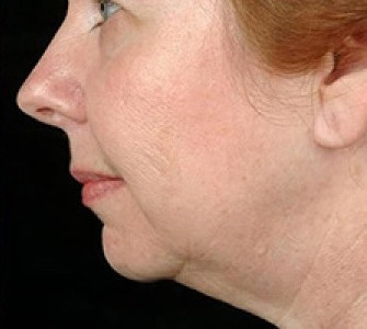 Full Face Thermage