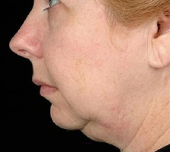 Full Face Thermage