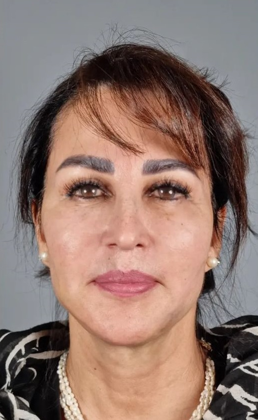 Facial Thread Lift