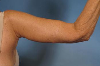 Upper Arm Lift