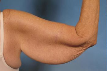 Upper Arm Lift