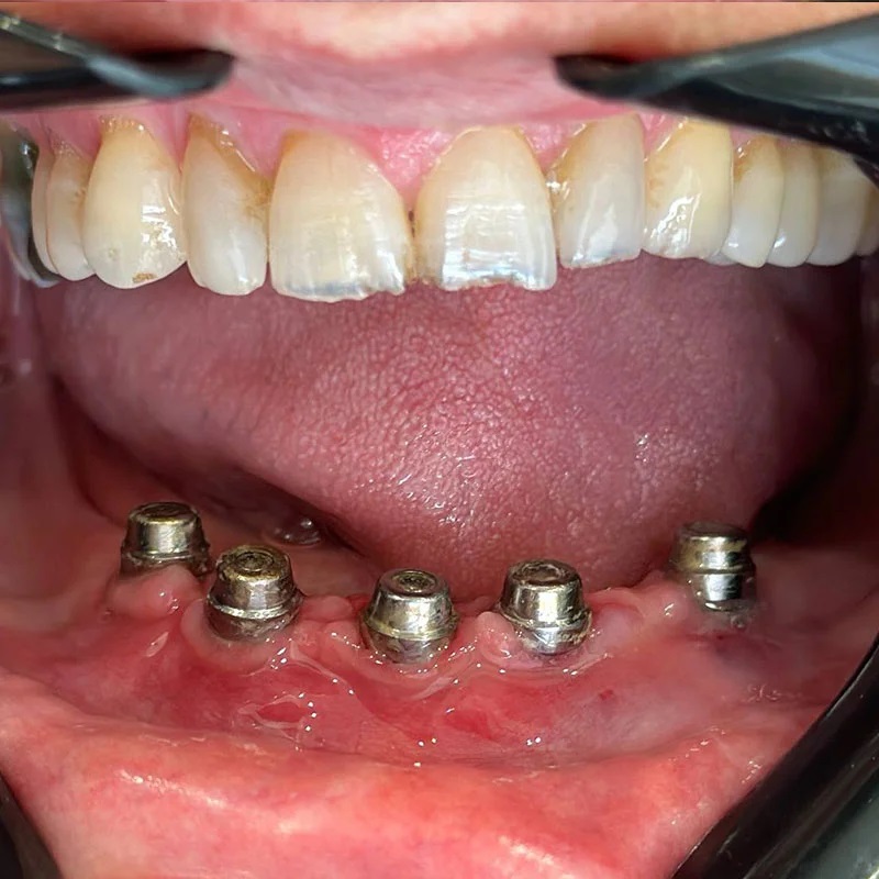Dental Implant