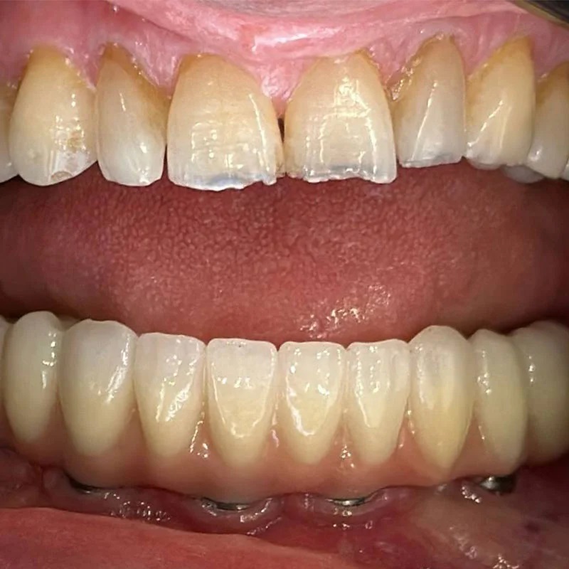 Dental Implant
