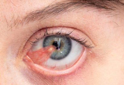 Into-Pterygium-scaled Into-Pterygium-scaled