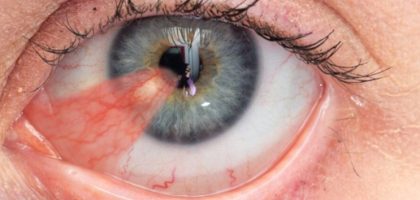 Into-Pterygium-top