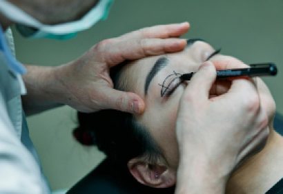blepharoplasty- scaled blepharoplasty- scaled