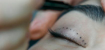 blepharoplasty2-scaled2
