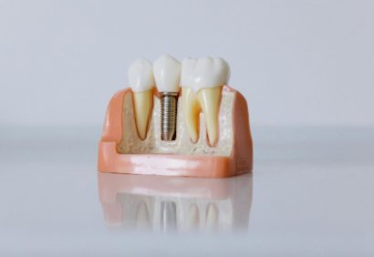 dental implant-scaled dental implant-scaled