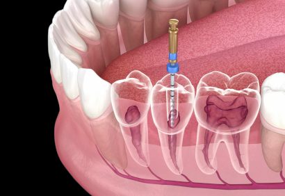 endodontic-scaled2 endodontic-scaled2